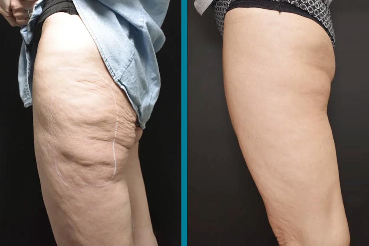 Redukcja cellulitu - Po